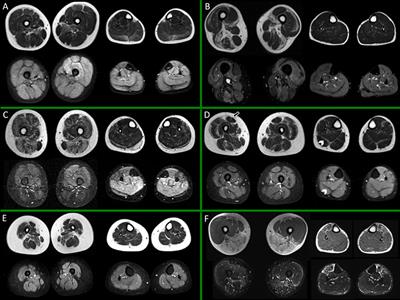 Advances in Quantitative Imaging of Genetic and Acquired Myopathies: Clinical Applications and Perspectives